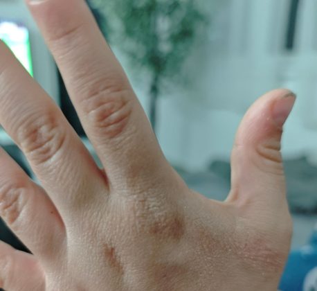 Crvenilo i osip na dečijim rukama nakon pranja u vrtiću