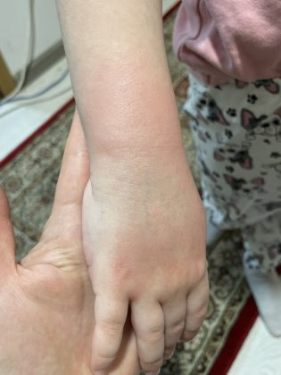 Dečije ruke sa vidljivim iritacijama i ekcemom nakon pranja ruku u vrtiću