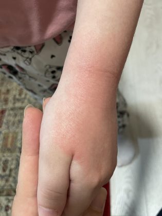 Crvenilo i osip na dečijim rukama nakon pranja u vrtiću