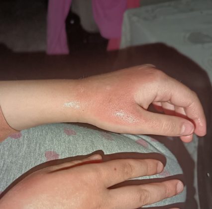 Dečije ruke sa vidljivim iritacijama i ekcemom